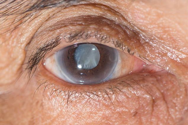Danger of Traditional Eye Medications: Ophthalmologist Warns Against Using Urine, Milk